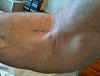 Bicep tendon rupture-2-post-op-9june2011.jpg