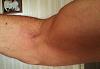 Bicep tendon rupture-4-post-op-21june2011.jpg