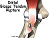 Bicep tendon rupture-dbt1.jpg