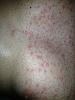 Terrible rash from waxing-image-1784066761.jpg