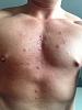 Nasty chest spots-image-4144057025.jpg