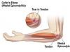 Golfers elbow - medial epicondylitis-golferselbowlabel-1-.jpg