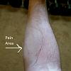 Forearm pain (with pics)-20161103_165000edited.jpg