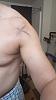 Shoulder Delt injury (left SHLder), kinda close to outer pec: what spot is this pls?-pectoralis-major-tendon-strain-pic-main.jpg