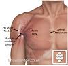 Shoulder Delt injury (left SHLder), kinda close to outer pec: what spot is this pls?-pectoralis-major-tendon-strain-pic-2.jpg