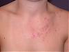 acne confused with &quot;Pityrosporum Folliculitis&quot;.  a MUST read for people with acne!!!!-pitfol2.jpg