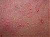 acne confused with &quot;Pityrosporum Folliculitis&quot;.  a MUST read for people with acne!!!!-pitfol3.jpg