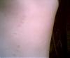 Lazer Hair Removal Burned ME!!-picture-002.jpg