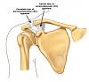 strained/sprained AC joint help-grade_ii_ac_joint_spr_pi_medium.jpg