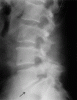 Lower back slipped disc-ag_010300spinaldisorders_spondy4_5-bb.gif