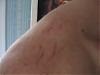 Are these stretch marks on my shoulder or just busted blood vessels?-4.jpg