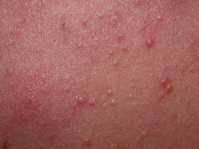 acne confused with 