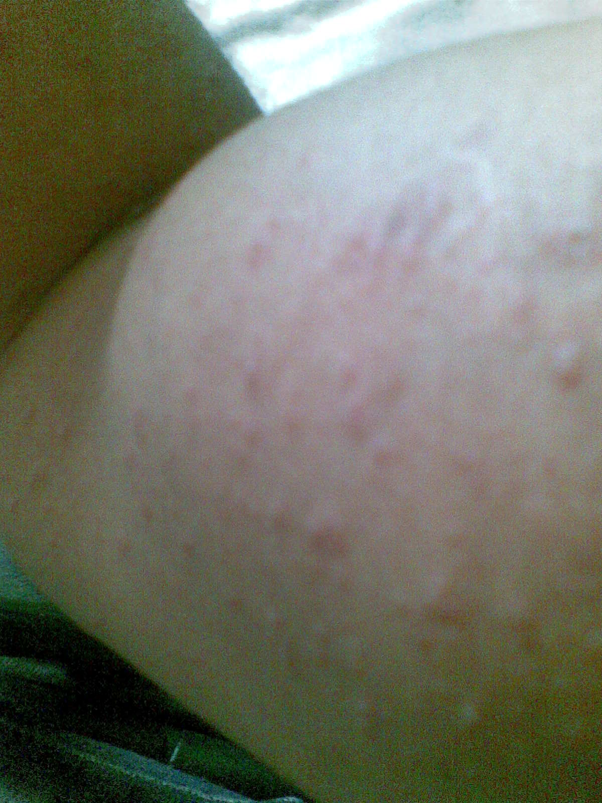 can diflucan cause skin rash